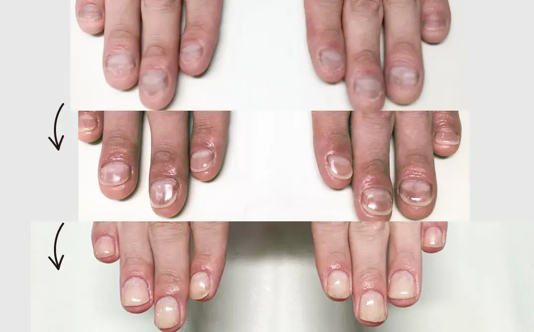 【メンズ/フット】深爪矯正～自爪再生３か月集中プログラム
