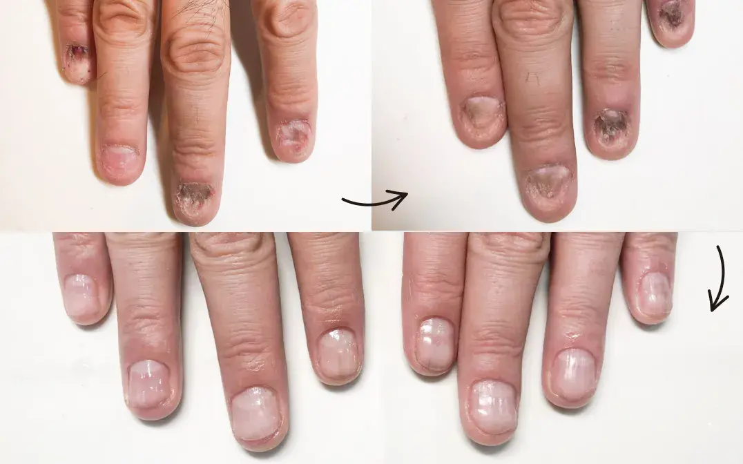 【メンズ/フット】深爪矯正～自爪再生３か月集中プログラム