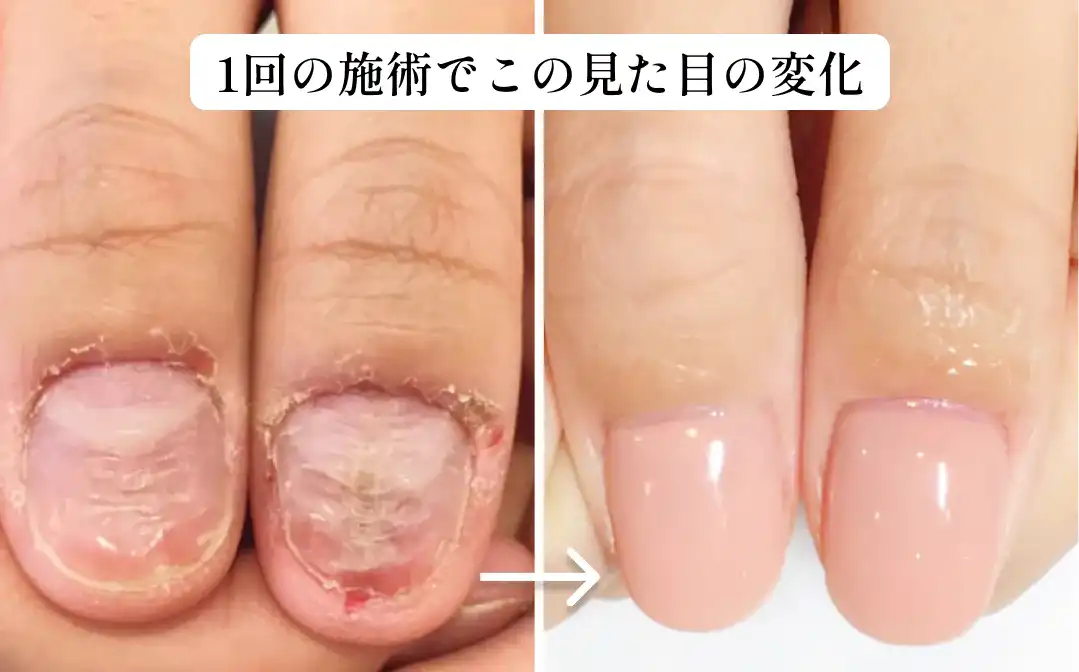 【ハンド】深爪矯正～美爪再生３か月集中プログラム