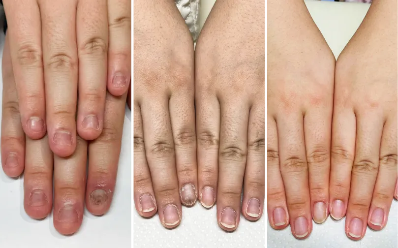 リカバリー4か月プログラム