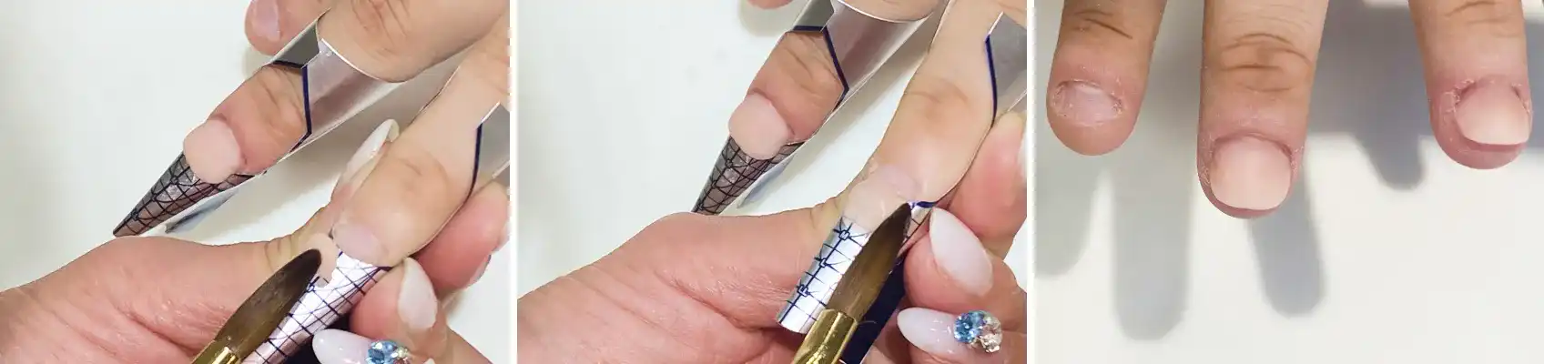 深爪矯正（仮爪ギブス装着）