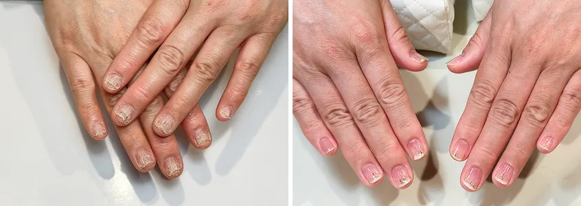 仮爪ギブス取り外し