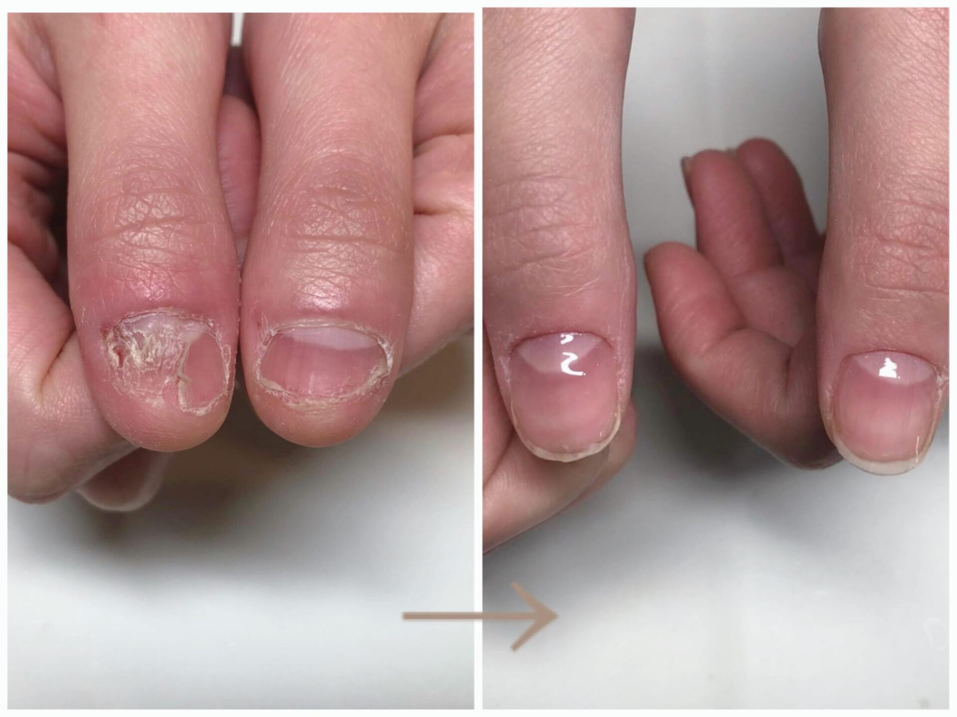 縦割れ爪の改善症例