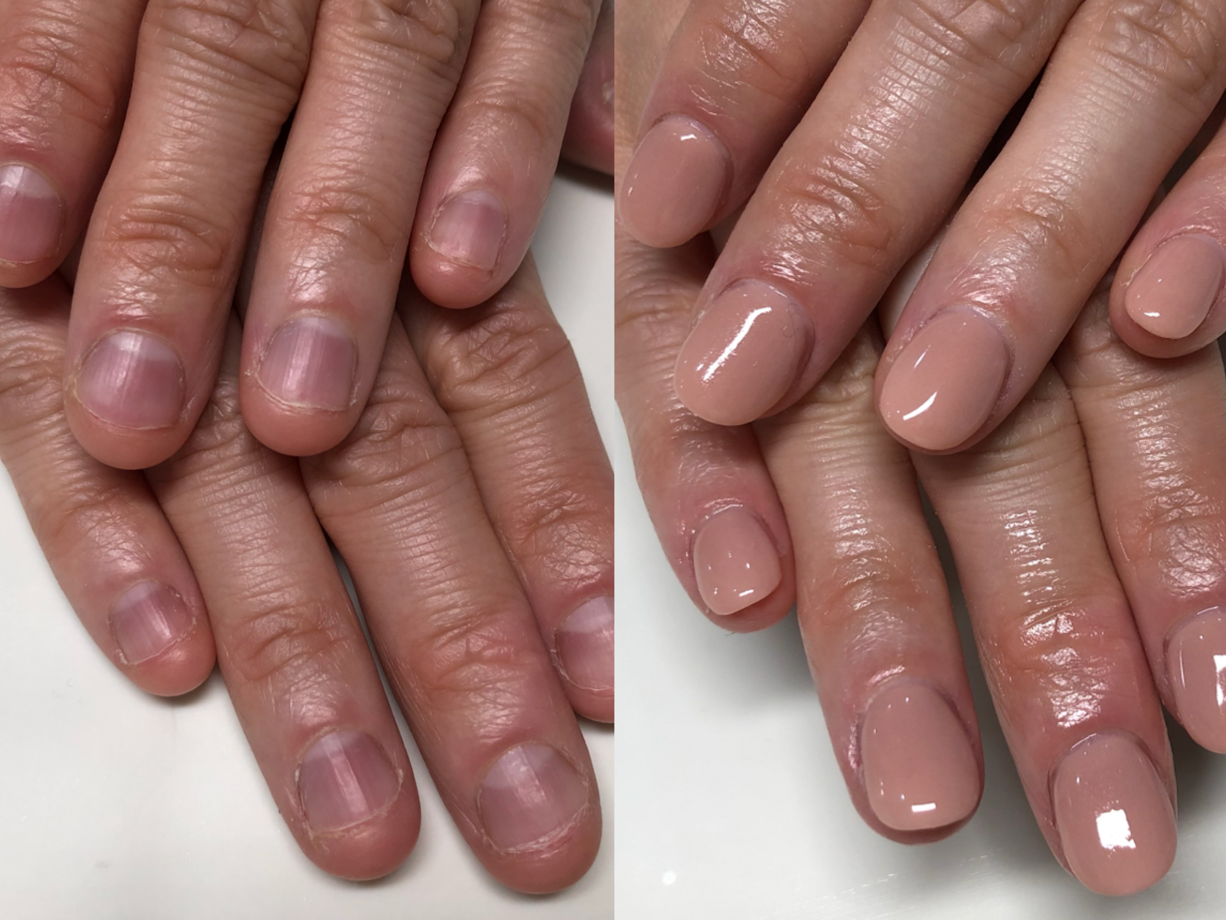 初回から自然に始められる深爪矯正