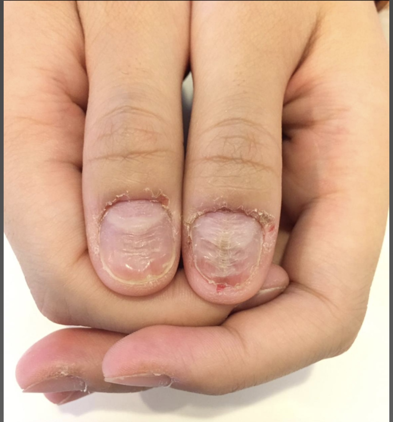 あえて傷を入れる深爪矯正