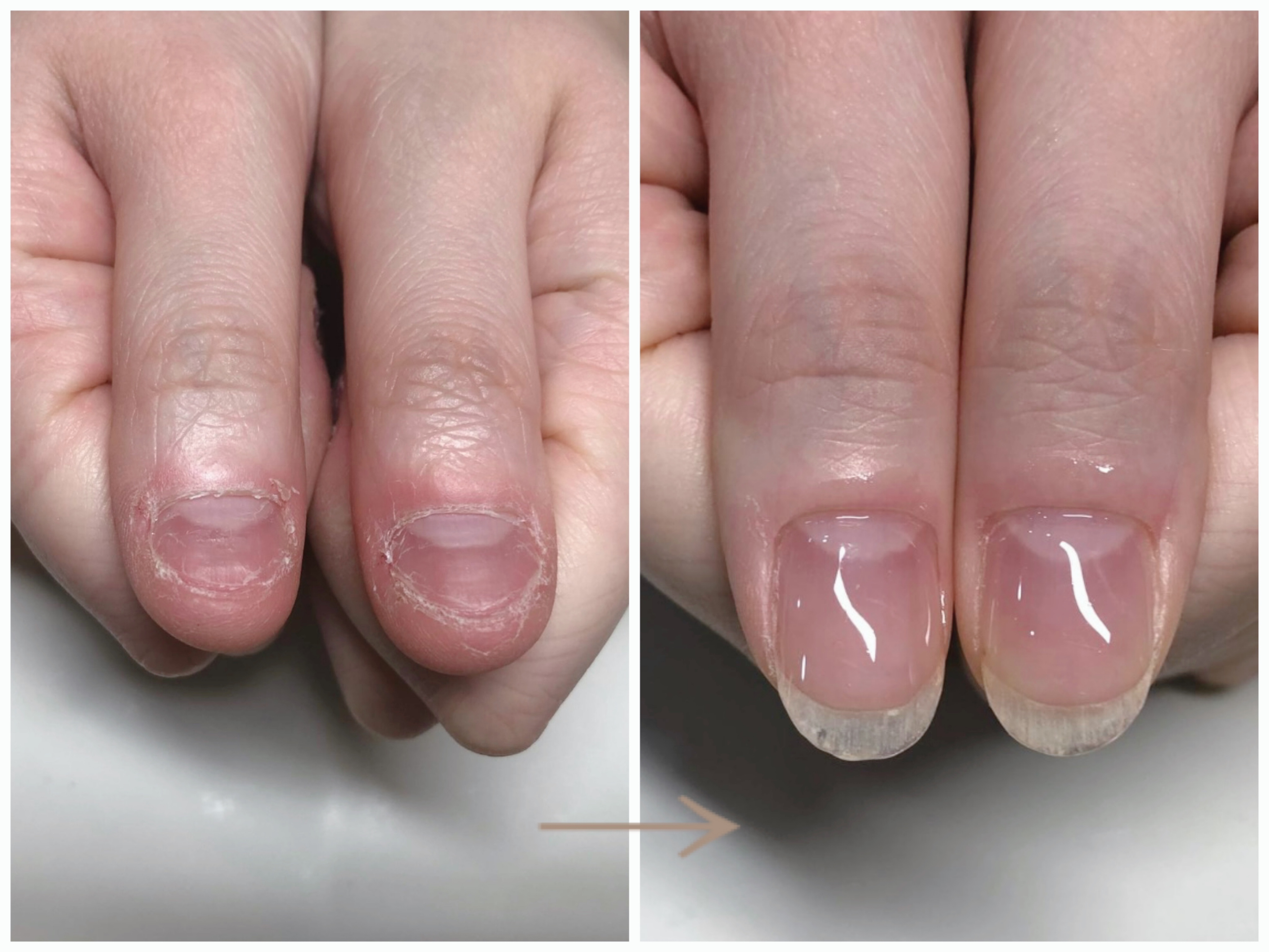 リプロネイル式深爪矯正結果写真