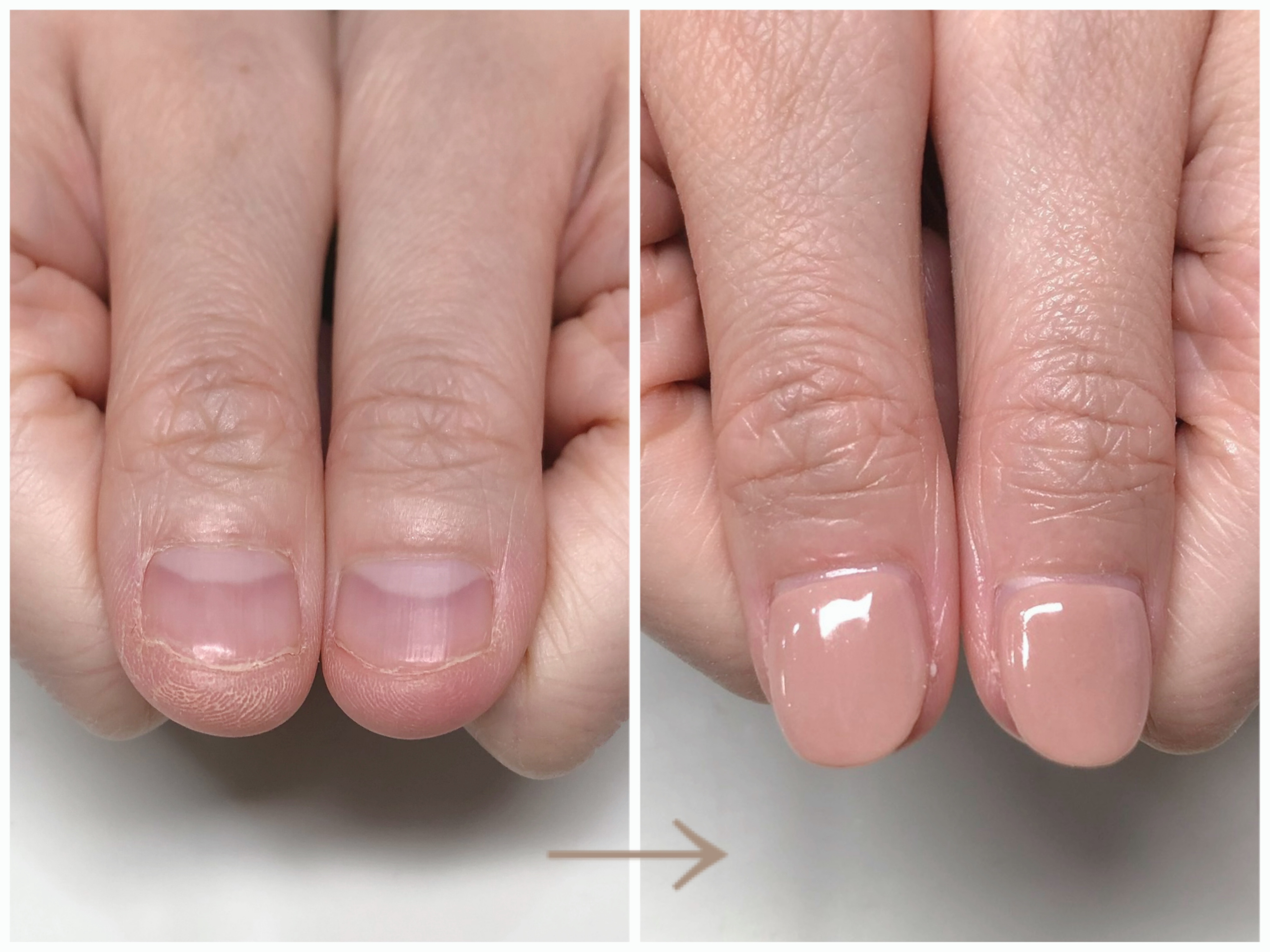 リプロネイル式深爪矯正結果写真
