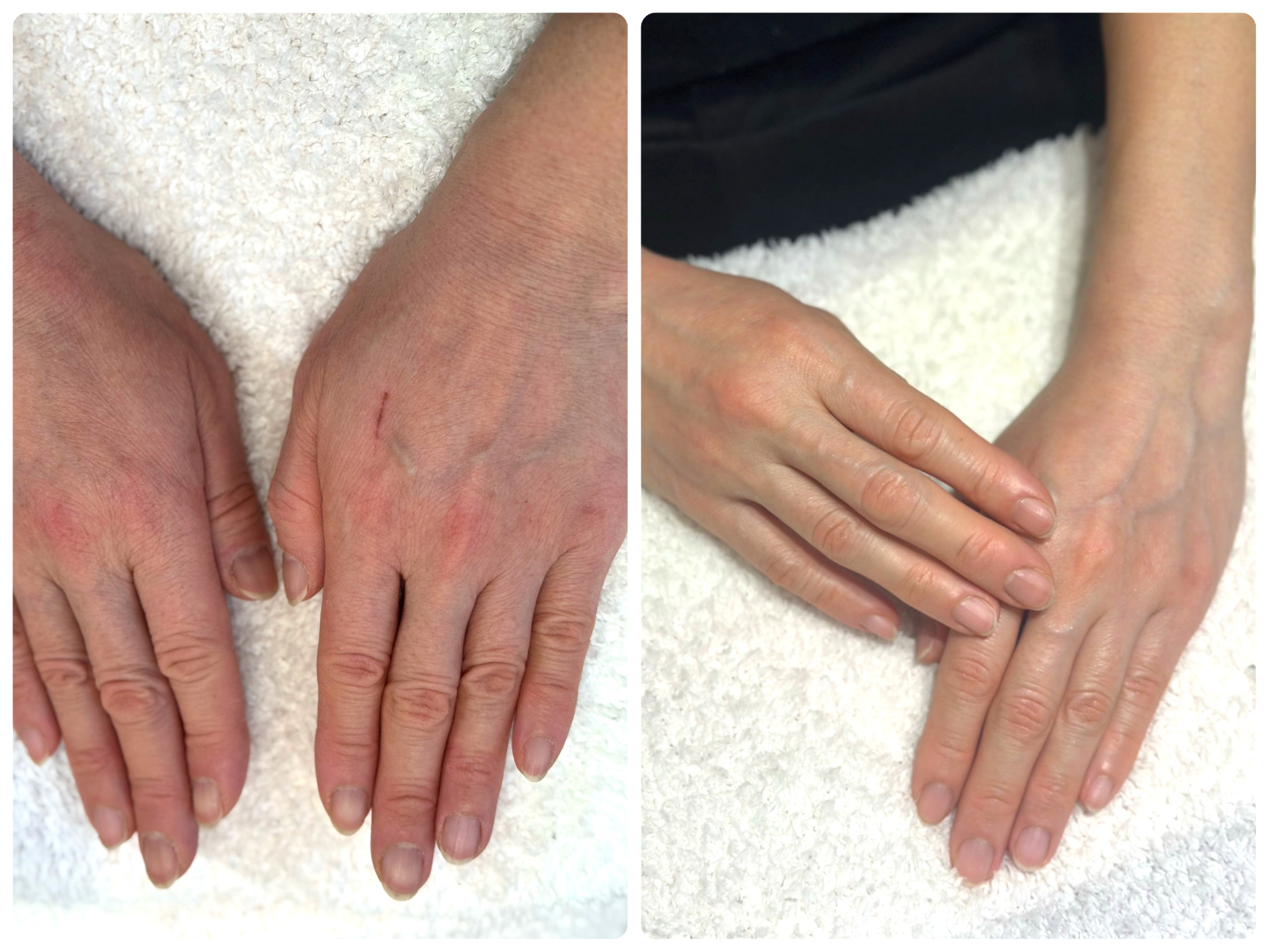 リプロネイル式深爪矯正リカバリーコースビフォーアフター