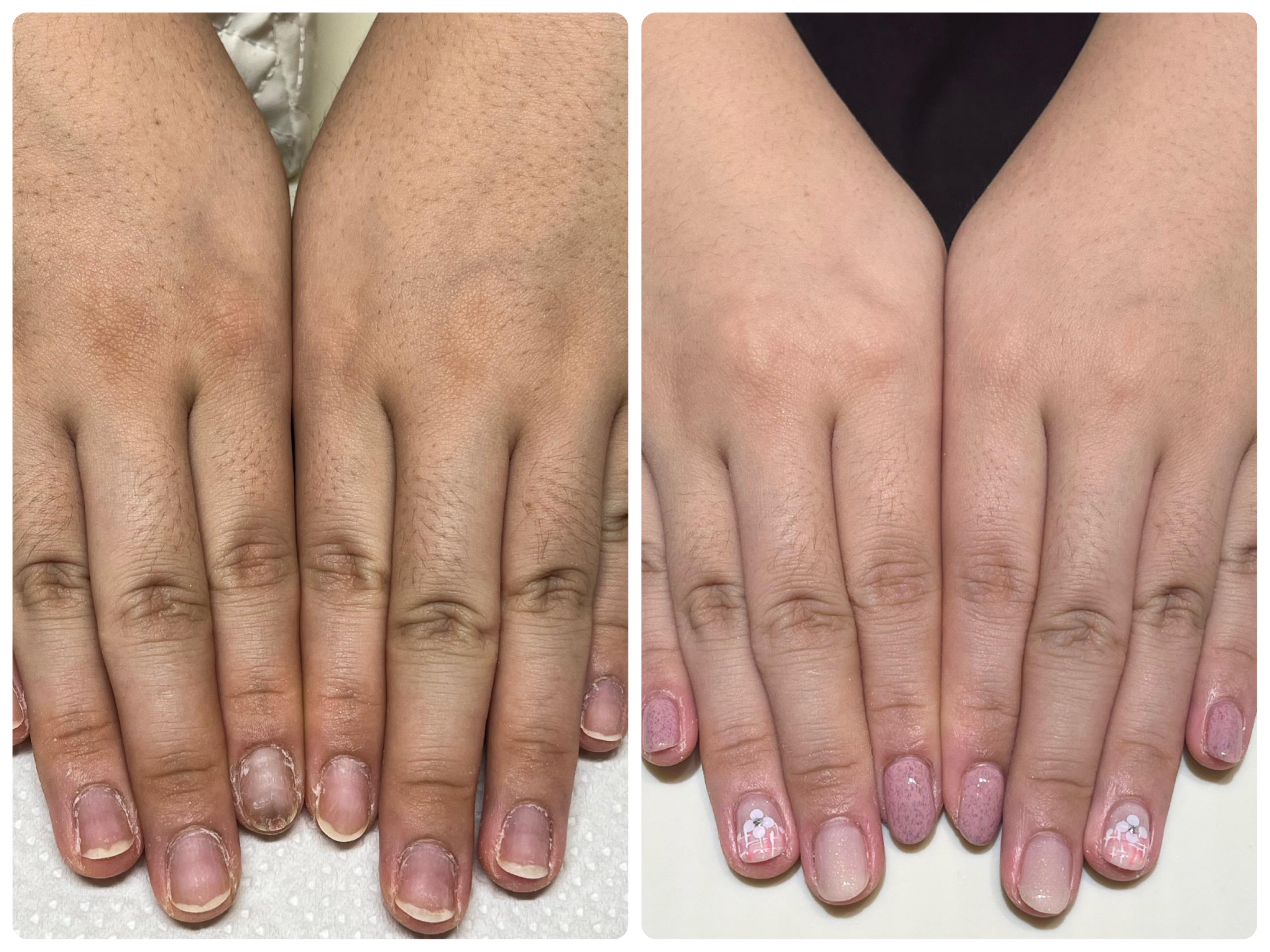 若い方でも悩む方も多い指の節の黒ずみ改善へのアプローチも可能