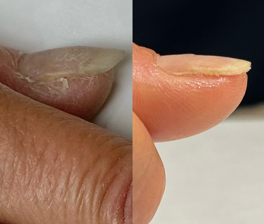 リプロネイル式深爪矯正の変化