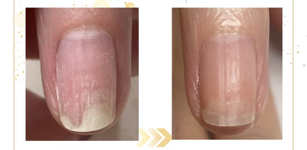 リプロネイル式深爪矯正の変化
