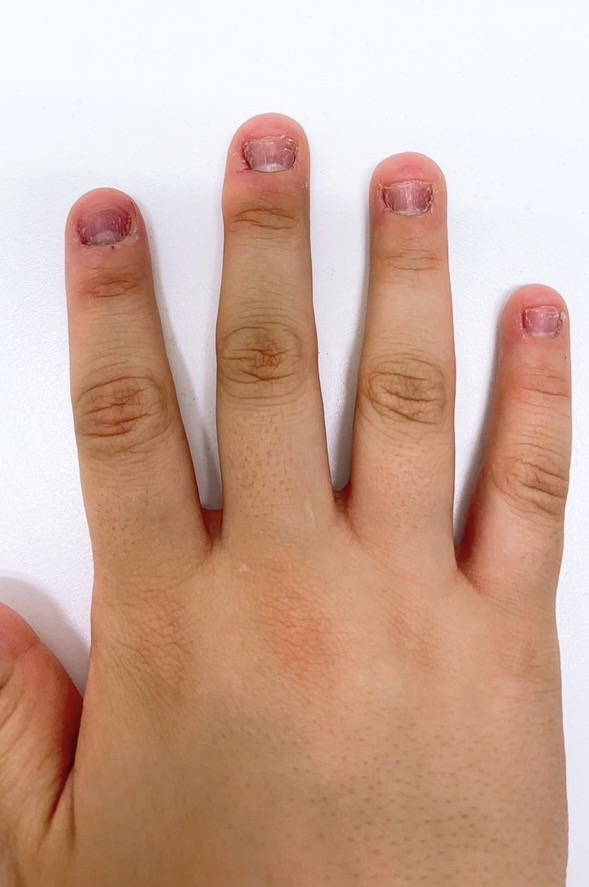 「やめると戻る」「深爪矯正はやっても再発する」と言われる深爪