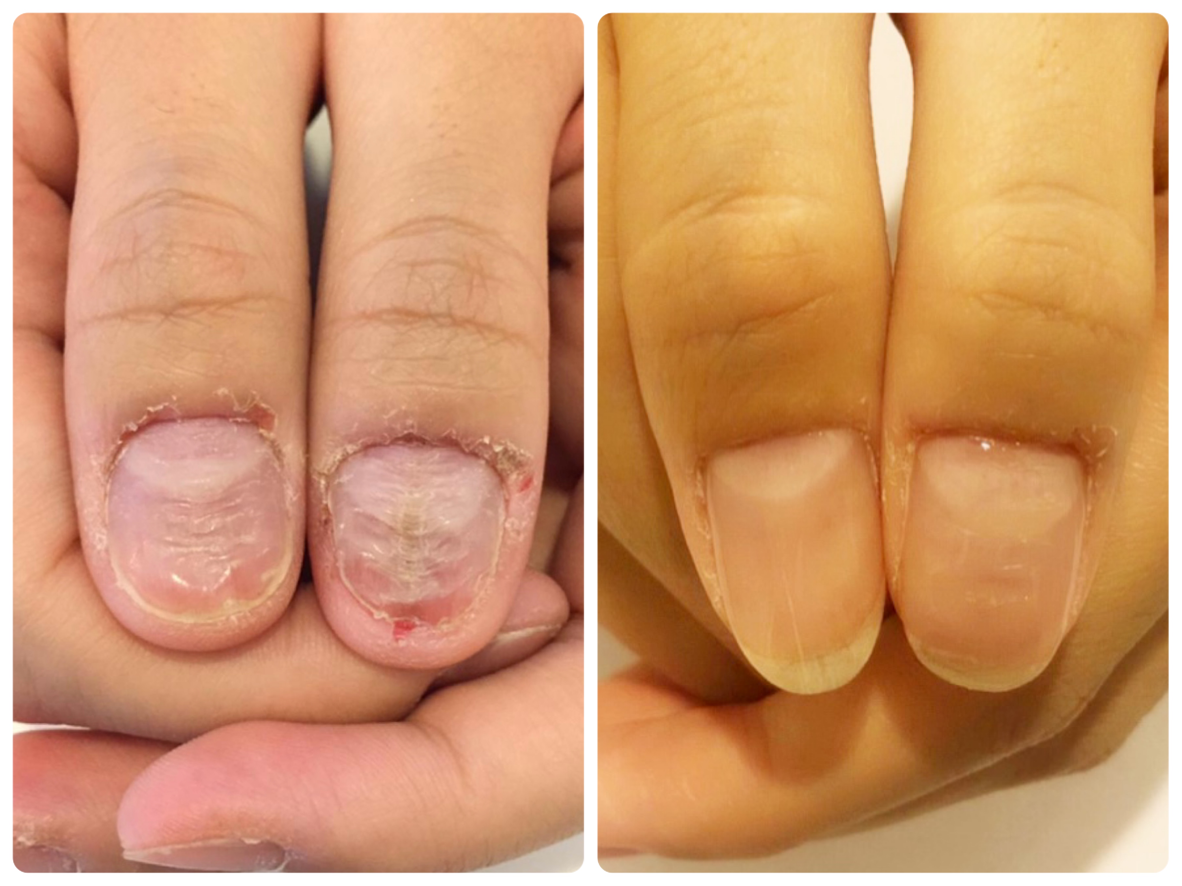 リプロネイル深爪矯正結果写真