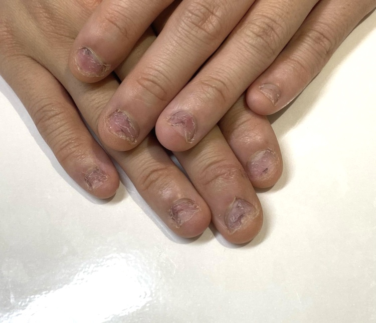 深爪・爪が変形している手