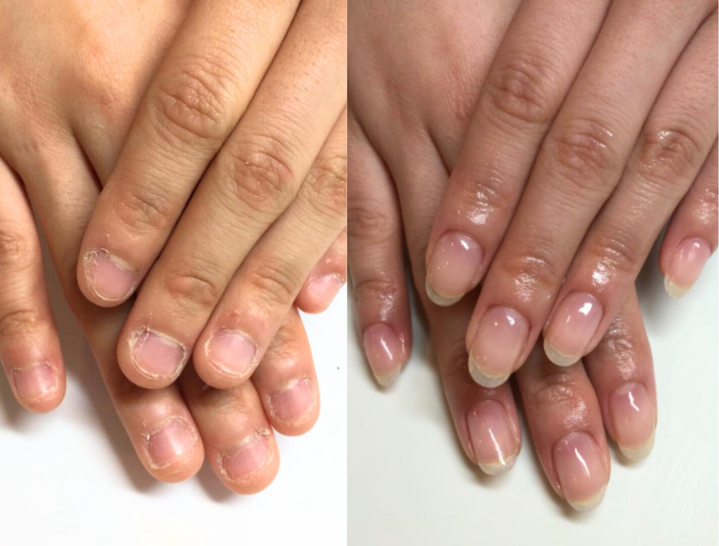 30代女性のリプロネイル深爪矯正4回の結果写真