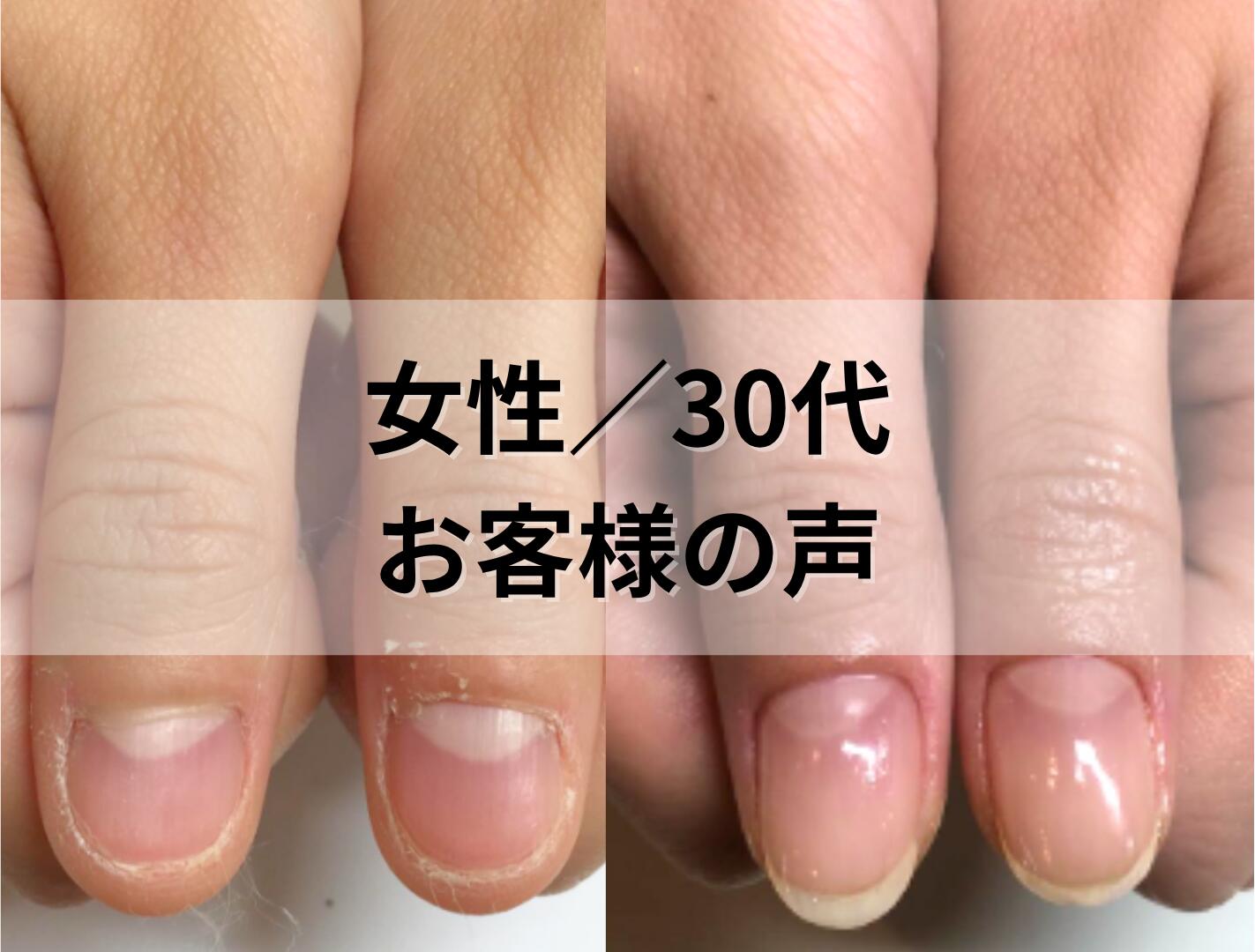 深爪矯正4回目、見た目だけでなく気持ちも楽になりました